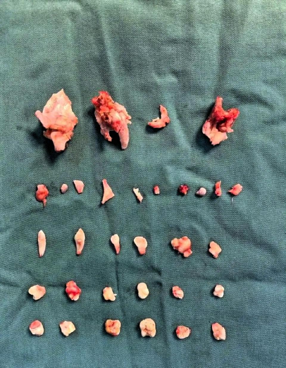 湖南长沙一位18岁女孩曾琳琳，前段时间在家跳操，跳着跳着右下腹突然开始剧烈疼痛，