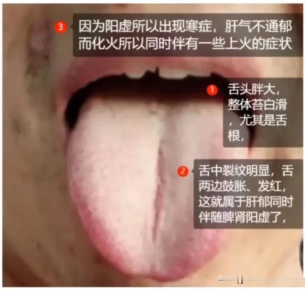 逍遥丸加一物，不仅疏肝，还健脾胃，调肝肾，化瘀血，去痰湿！

1、逍遥丸+小建中