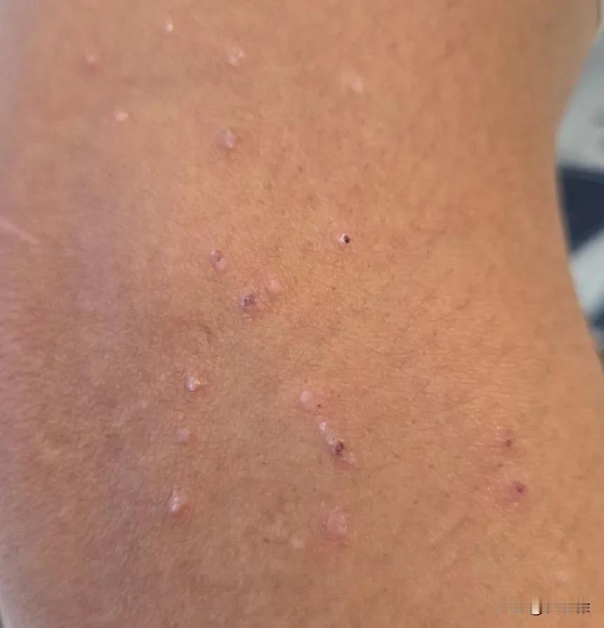 扁平疣有传染性，这个病人胳膊和腿上长的扁平疣数下来大约有小一百个，用了咪喹莫特乳