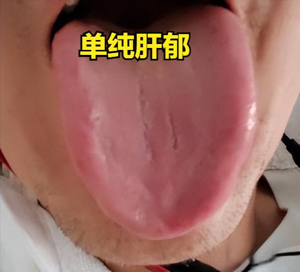 一、舌象辨证：跳出 “脾虚” 误区，认准 “肝火 + 湿热” 信号
消化、上火问