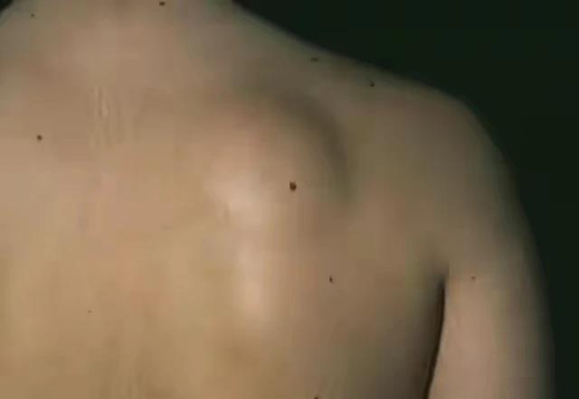 你是否为身上的脂肪瘤而烦恼？今天我要介绍的是一位老中医朱进忠的特效方，让你轻松摆