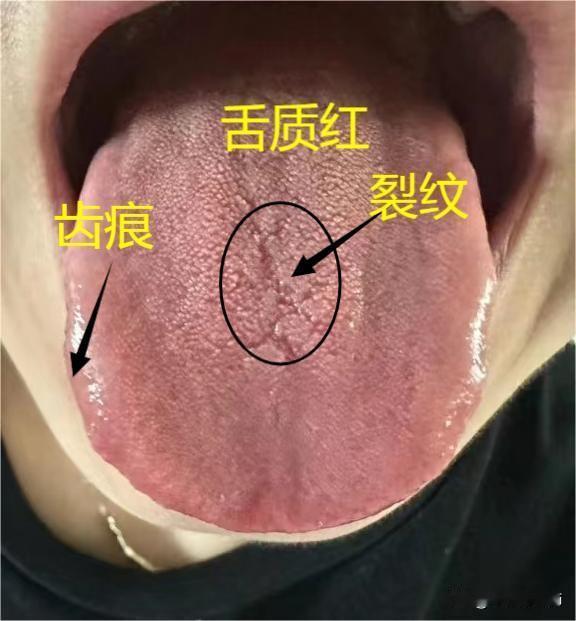 粉丝舌象分析：
从你的舌象看，你目前是湿热的体质，阴虚火旺了已经。就是湿气太重，