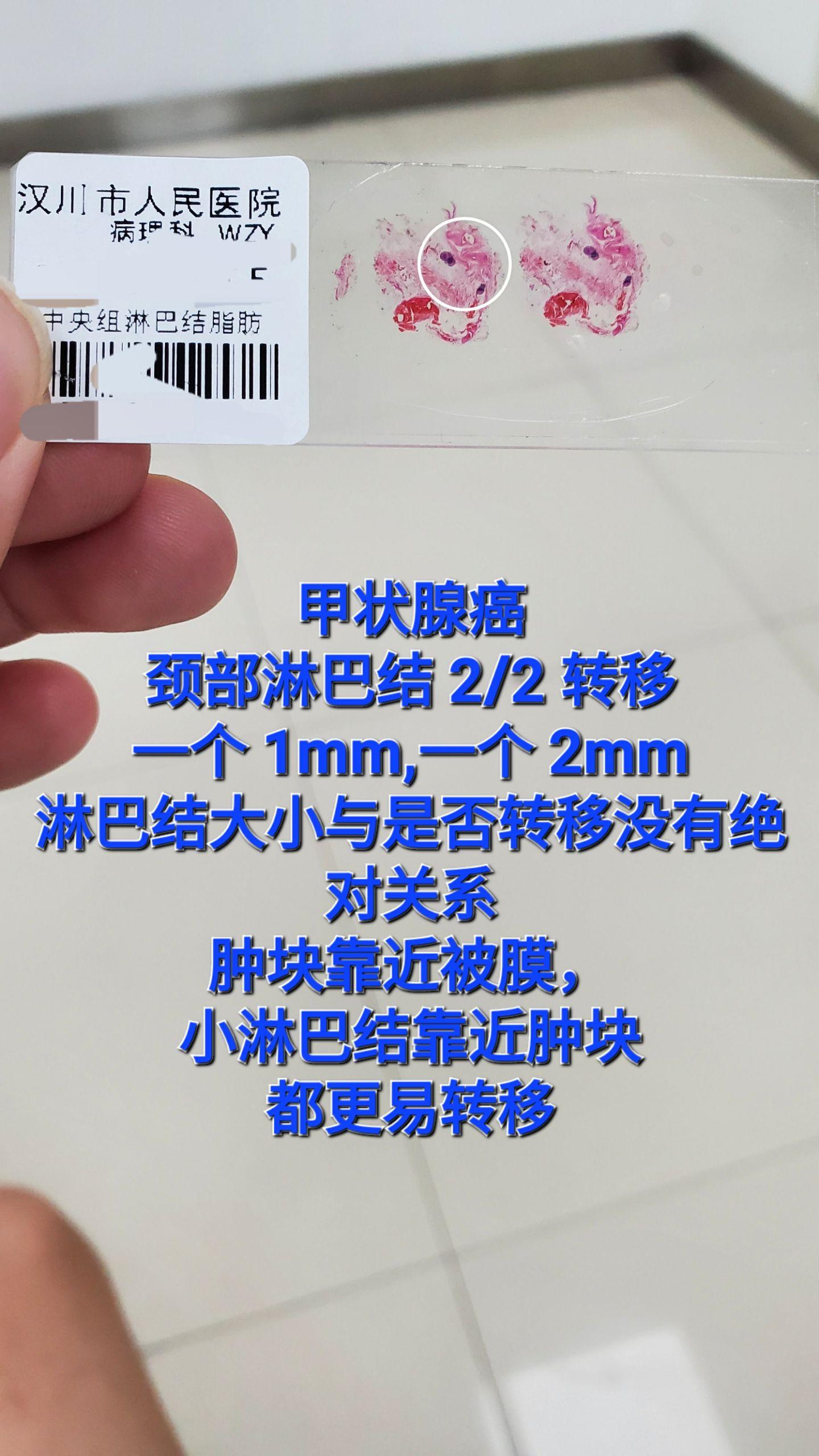 甲状腺乳头状癌
淋巴结转移