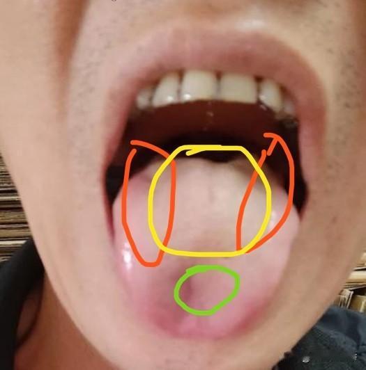 评论区舌诊实战分享，这张照片呢比较模糊，我们只能做个大致判断
中焦郁滞不通：肝气