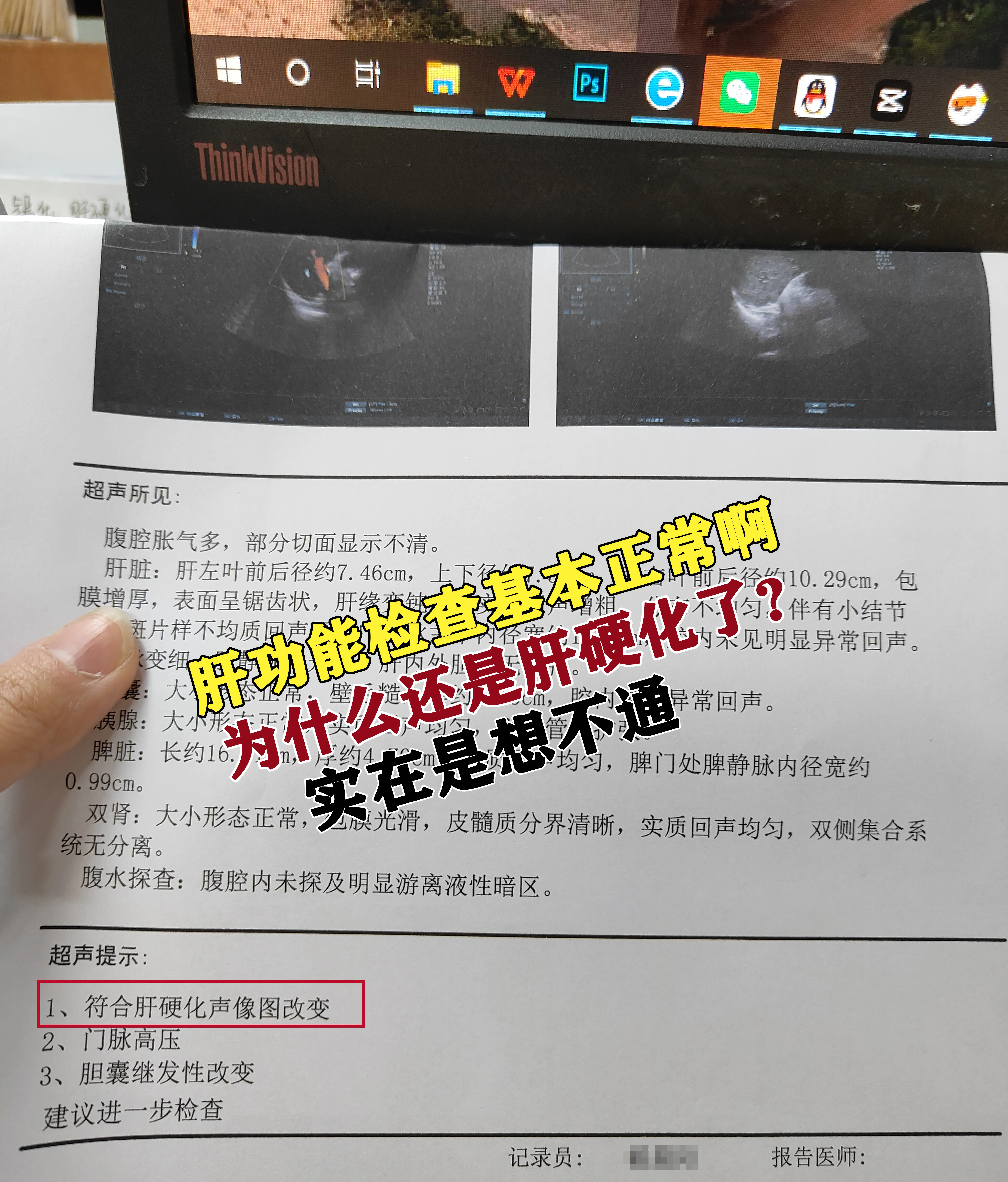 你这样的情况太多了！。“实在是想不通，明明肝功能都是正常的，怎么还肝硬...
