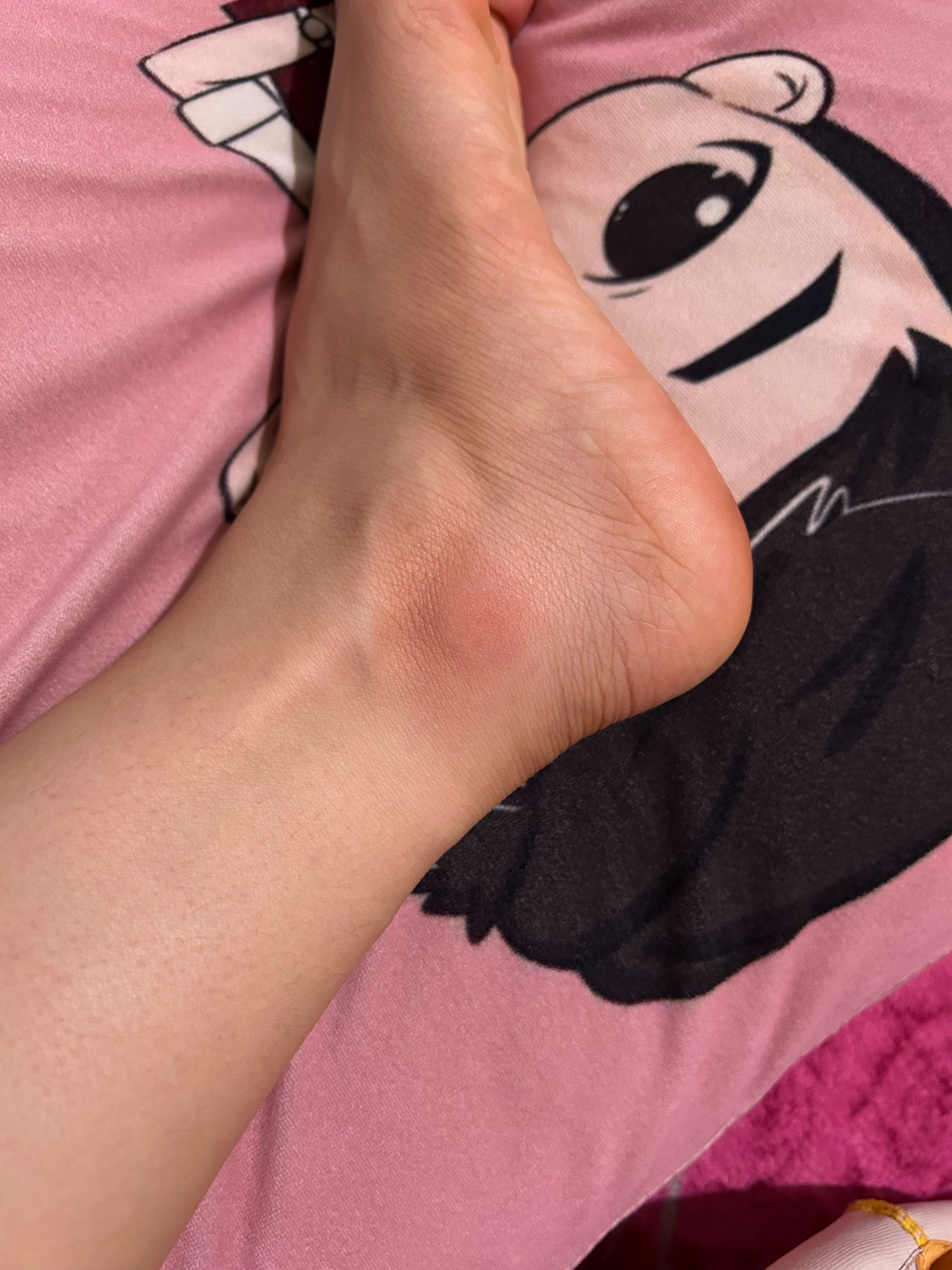 昨天早上这只是一个很小很小的小包，昨晚就开始变红了，今天感觉这么大了，很痒，很痒