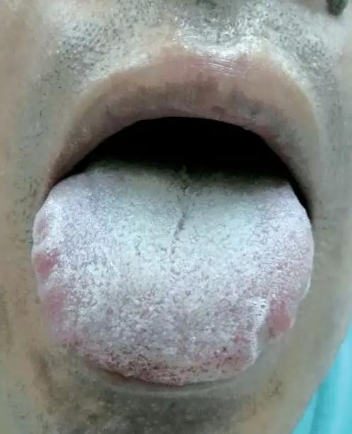 痰瘀互结生百病啊！这样一种舌象，舌苔厚腻，发白，就像抹了一层猪油一样，典型的痰湿