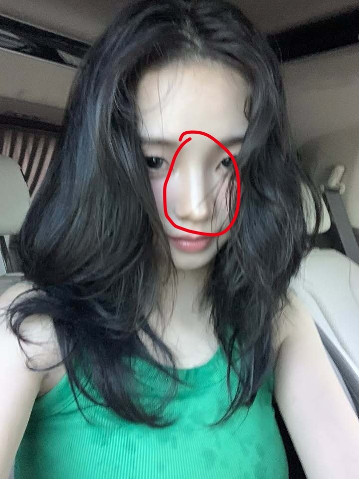 假体突出给自己整成盒型鼻了 