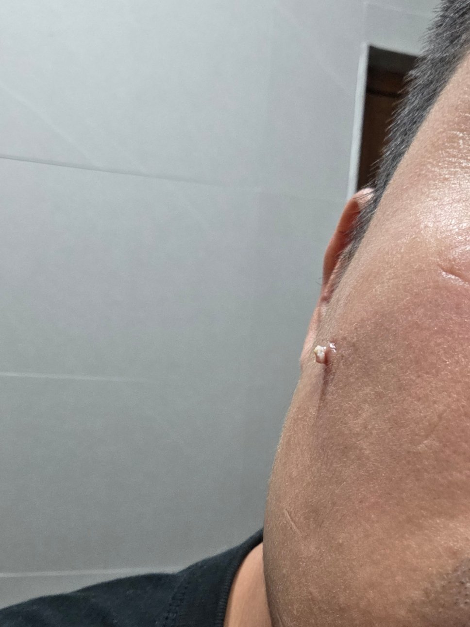 右脸有个痘疮长了三四年一直消不掉今年大年初三感觉它隐隐作痛尝试用力挤了挤几年来无