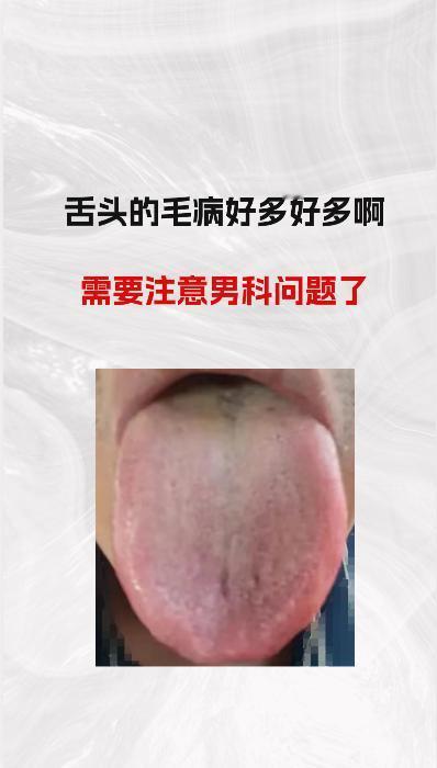 看这个舌头毛病真的好多好多啊 ！！需要注意 “男科” 方面的问题了