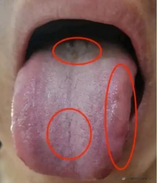 男人舌头上出现这三点，不是萎弱不起，阴囊潮湿，就是前列腺炎！

①.脾胃气虚，湿