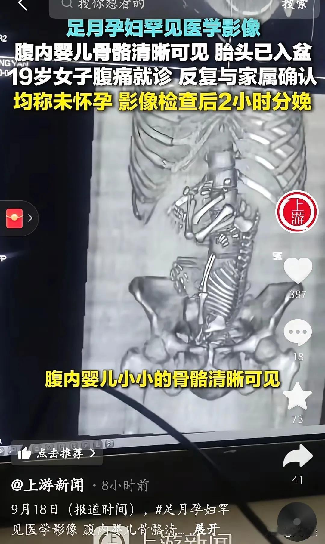 真稀奇！

19岁女子因腹痛，被家人送到医院就诊，医生反复询问。又没有怀孕，家人