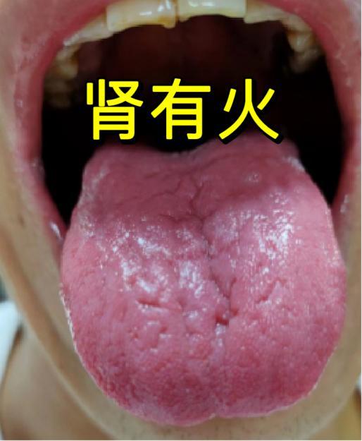 大家好，我是中医陈大夫！不少朋友一过中年，就总被潮热盗汗、头晕耳鸣、腰膝酸软缠上