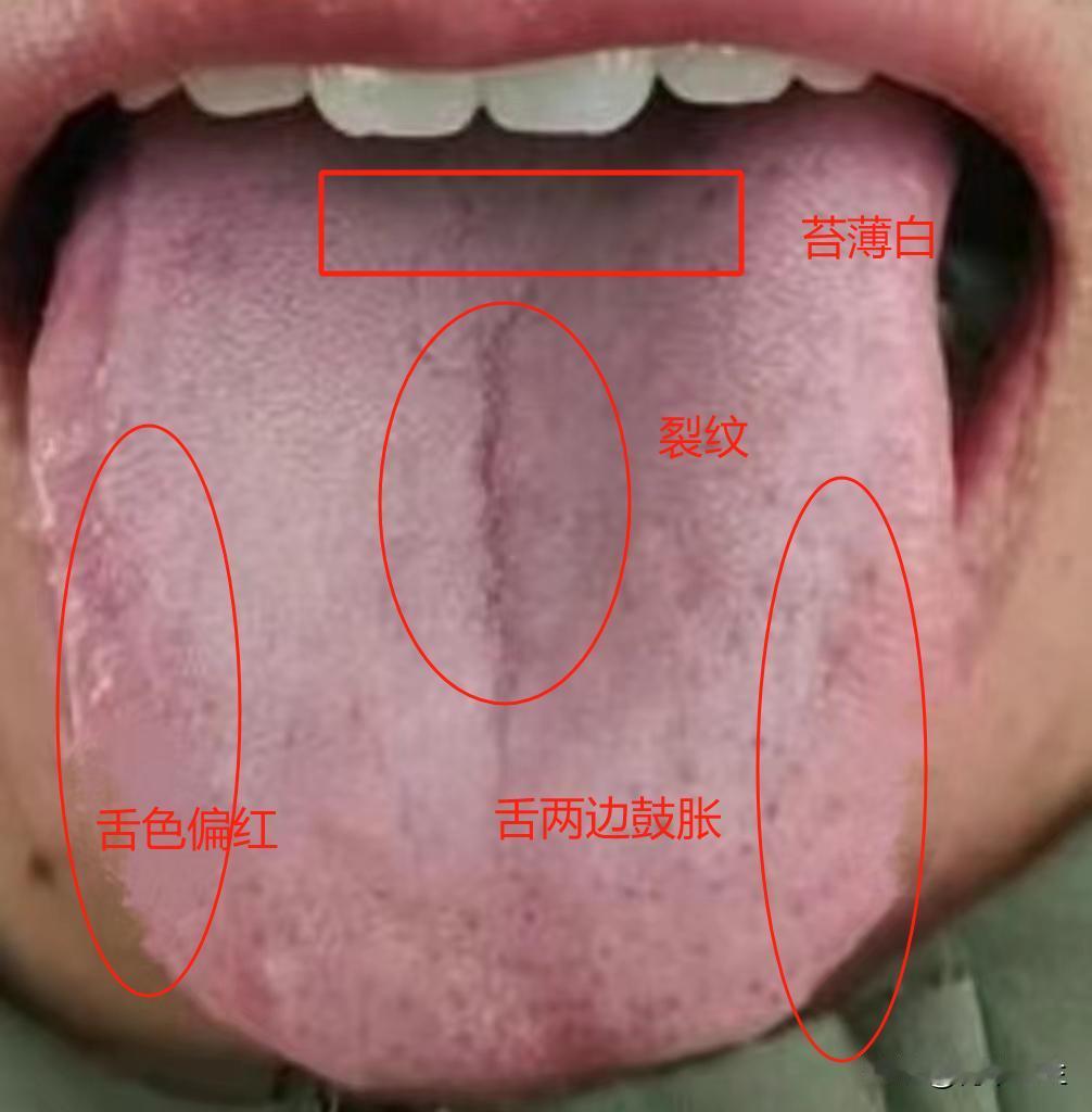 逍遥丸不是万能的，这样的肝郁，用它根本没用，还会越来越严重

逍遥丸的名声想必很