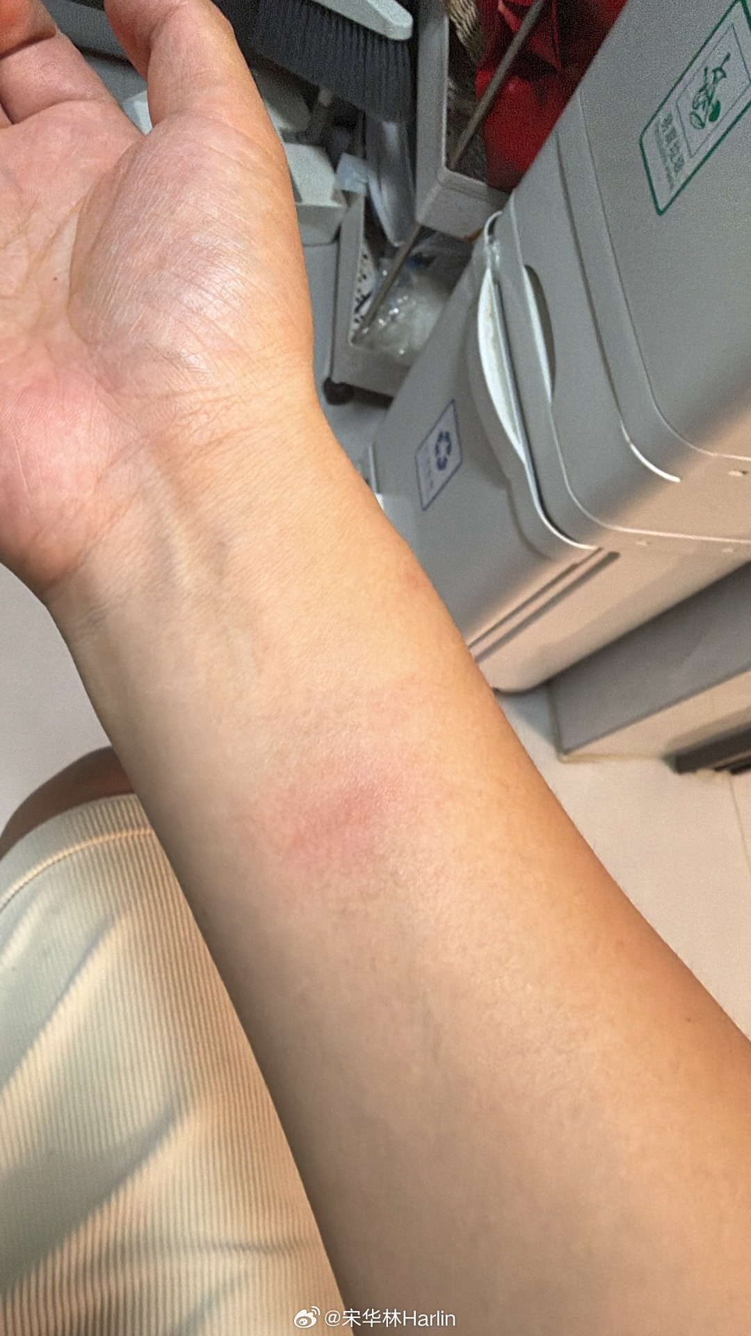 做饭给胳膊烫了