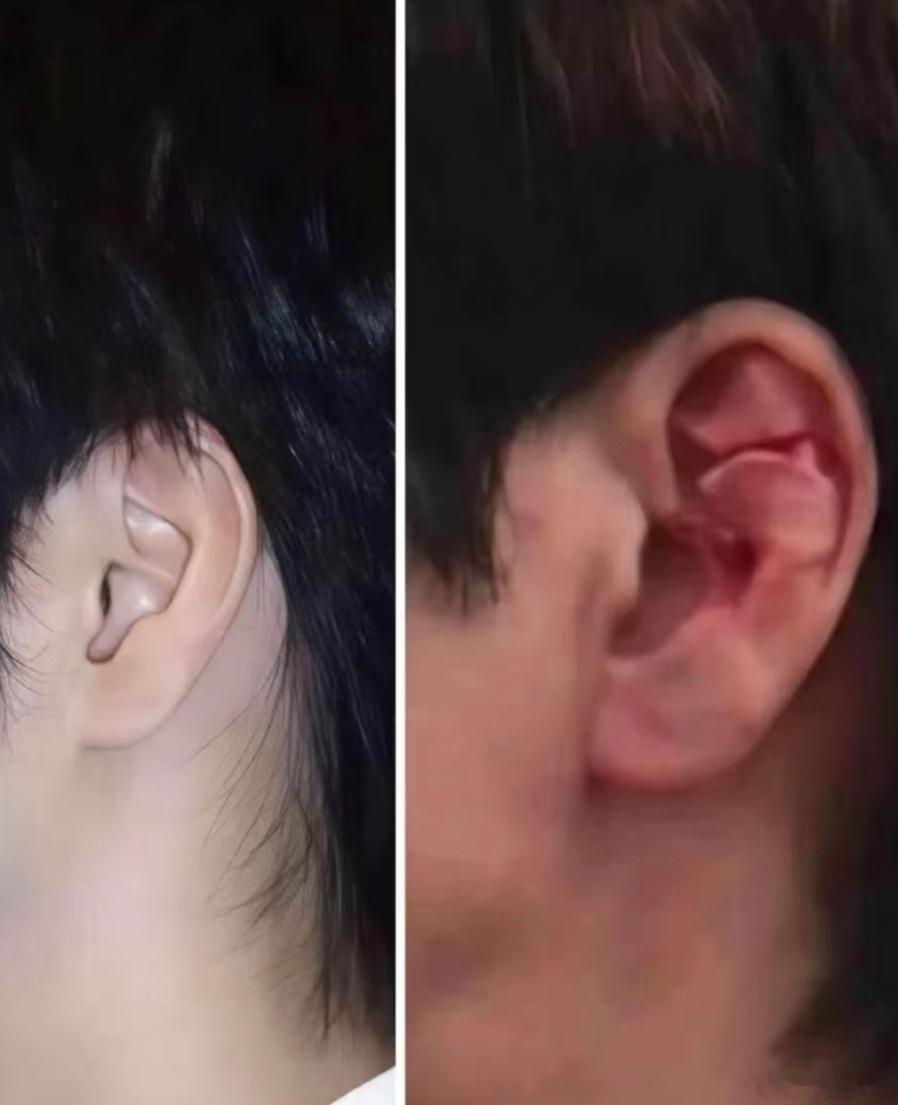 王力宏摔倒看到视频了，感觉摔的还蛮严重的，耳朵软骨那块感觉像是被台阶直接切割伤了