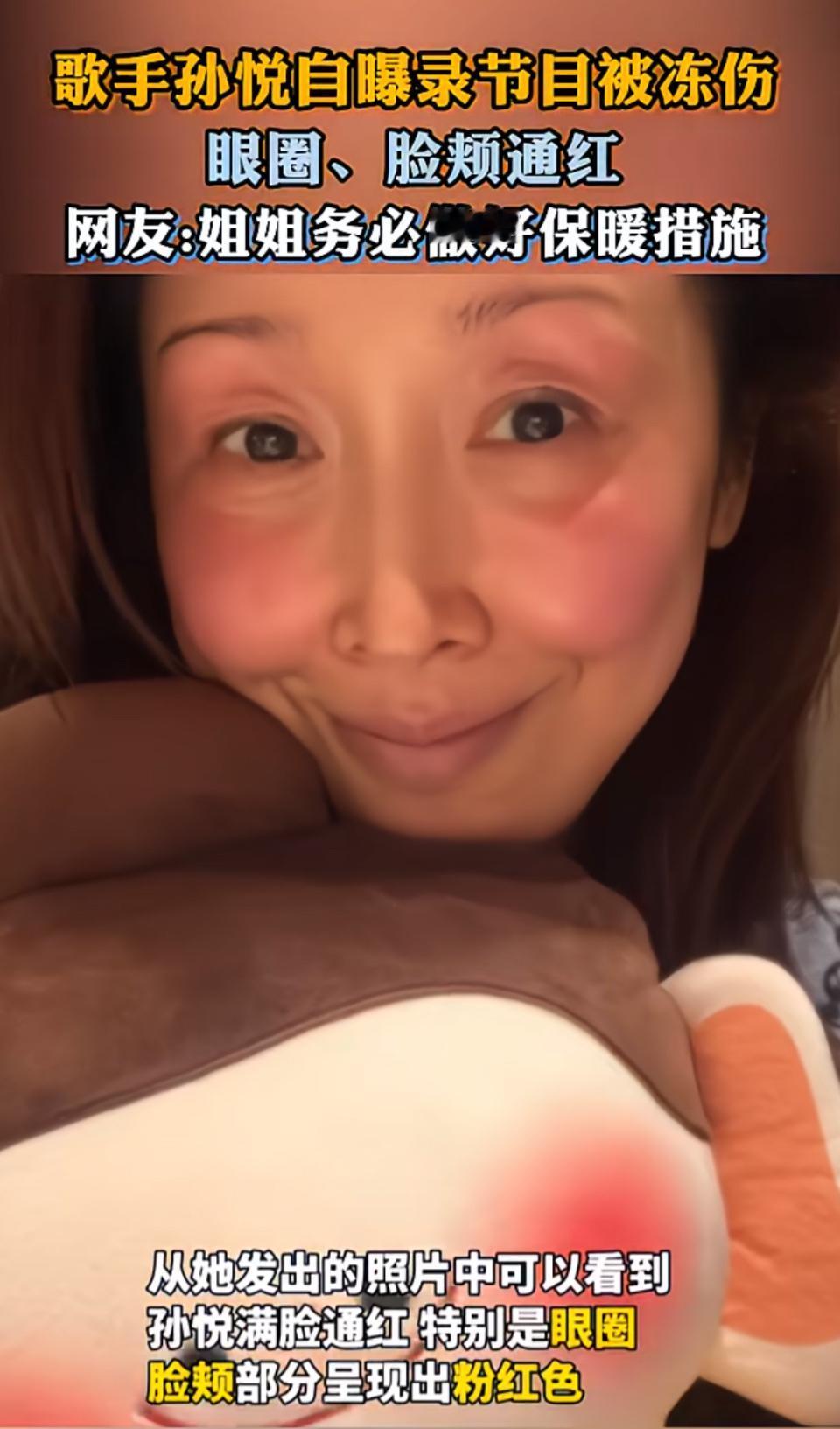 歌手孙悦自曝节目录制被冻伤，眼圈、脸颊通红，网友提醒保暖！据悉，此次孙悦是在录制