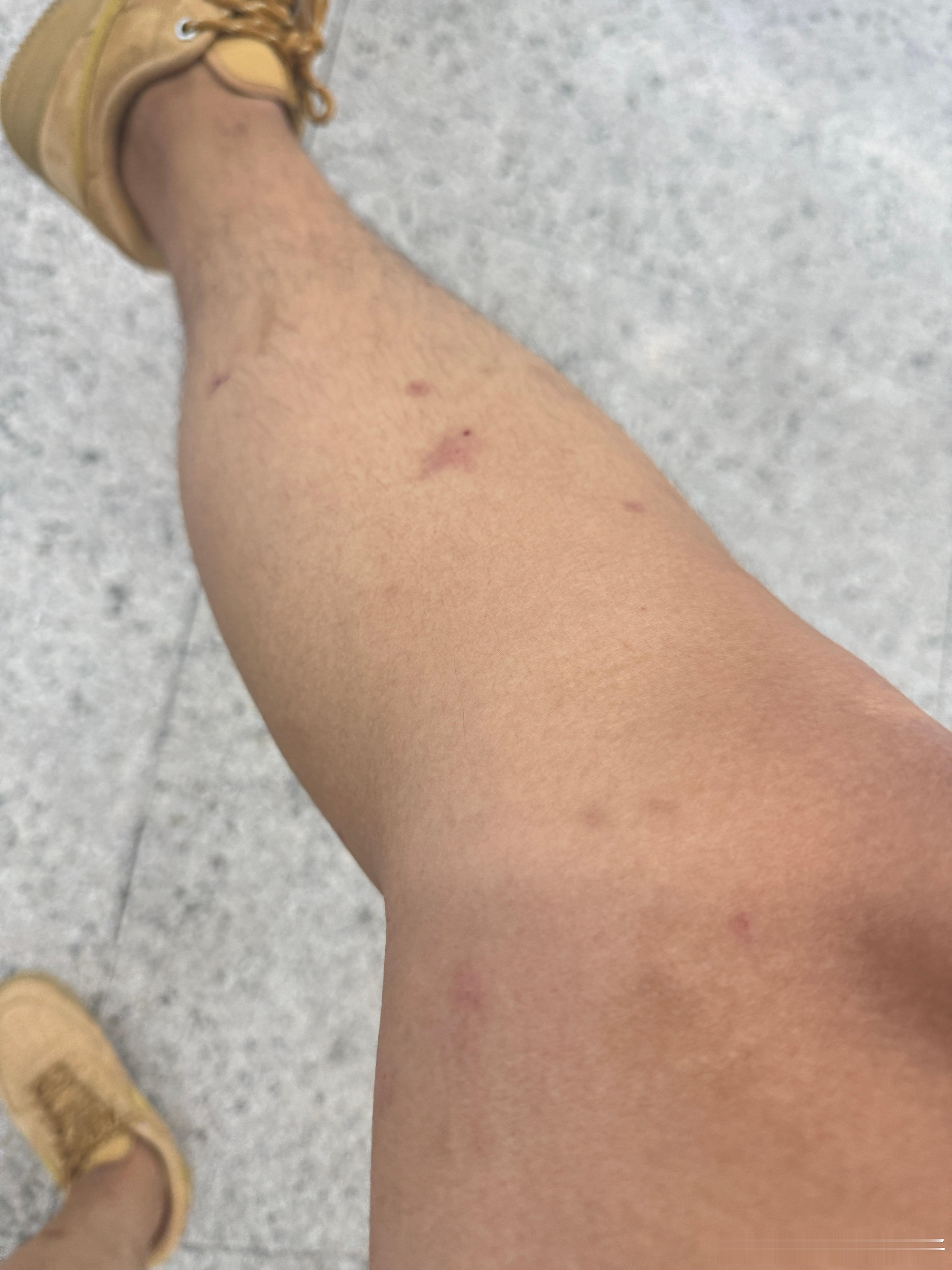 这个月跟深圳干上了真不想来，深圳蚊子跟变异了似的干个活，车下面站半小时腿就让蚊子