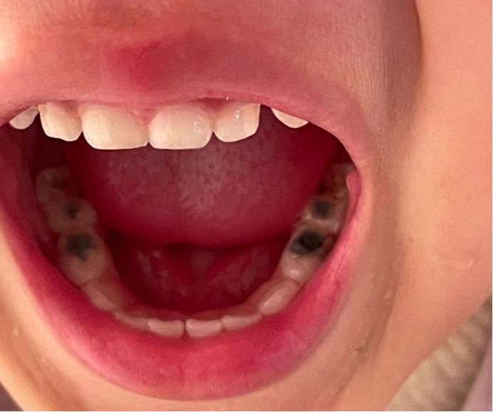 孩子牙齿又黄又黑，还长蛀牙，3个方法，宝宝爱上刷牙不长龋齿。
 
孩子长蛀牙时，