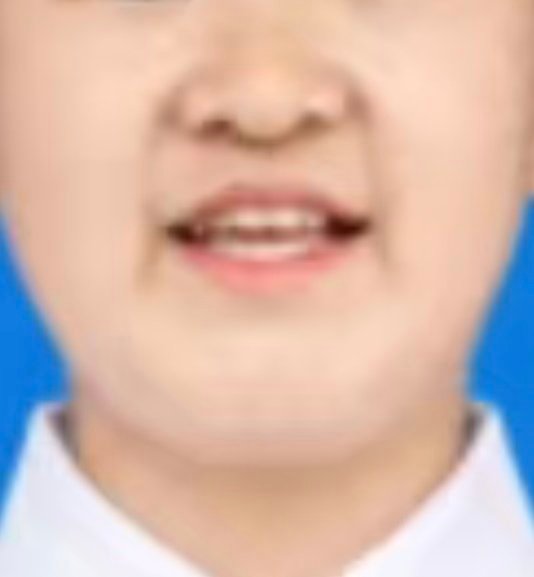 法令纹紧紧夹着鼻子和嘴巴的不好，为苦相。小时候有父母罩着可能感觉不到。一旦成年独