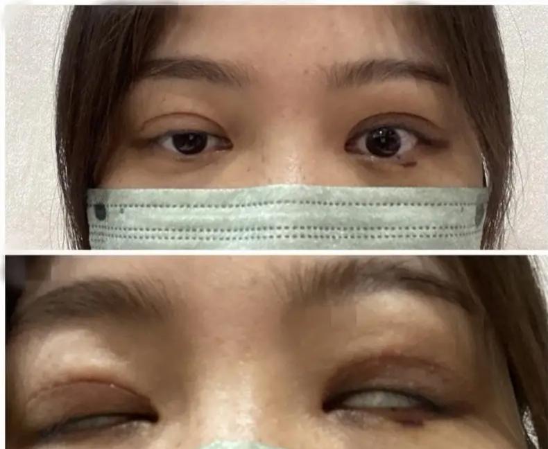 很多女生做医美，只是想微调变好看一点，没想到简简单单一个双眼皮手术，直接把一辈子