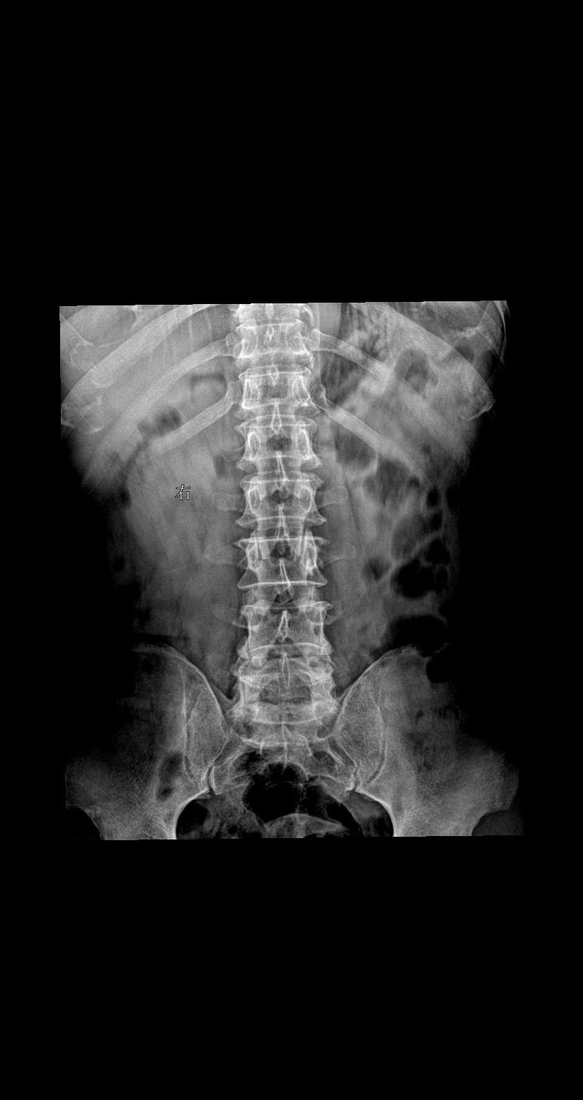 男 55 腰部疼痛就诊