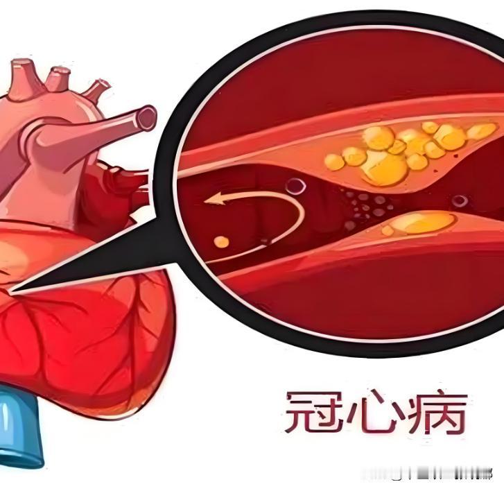 巧治冠心病，3个妙方教给你，堪比“天然支架”！

1、心血淤堵。

原理：心主血