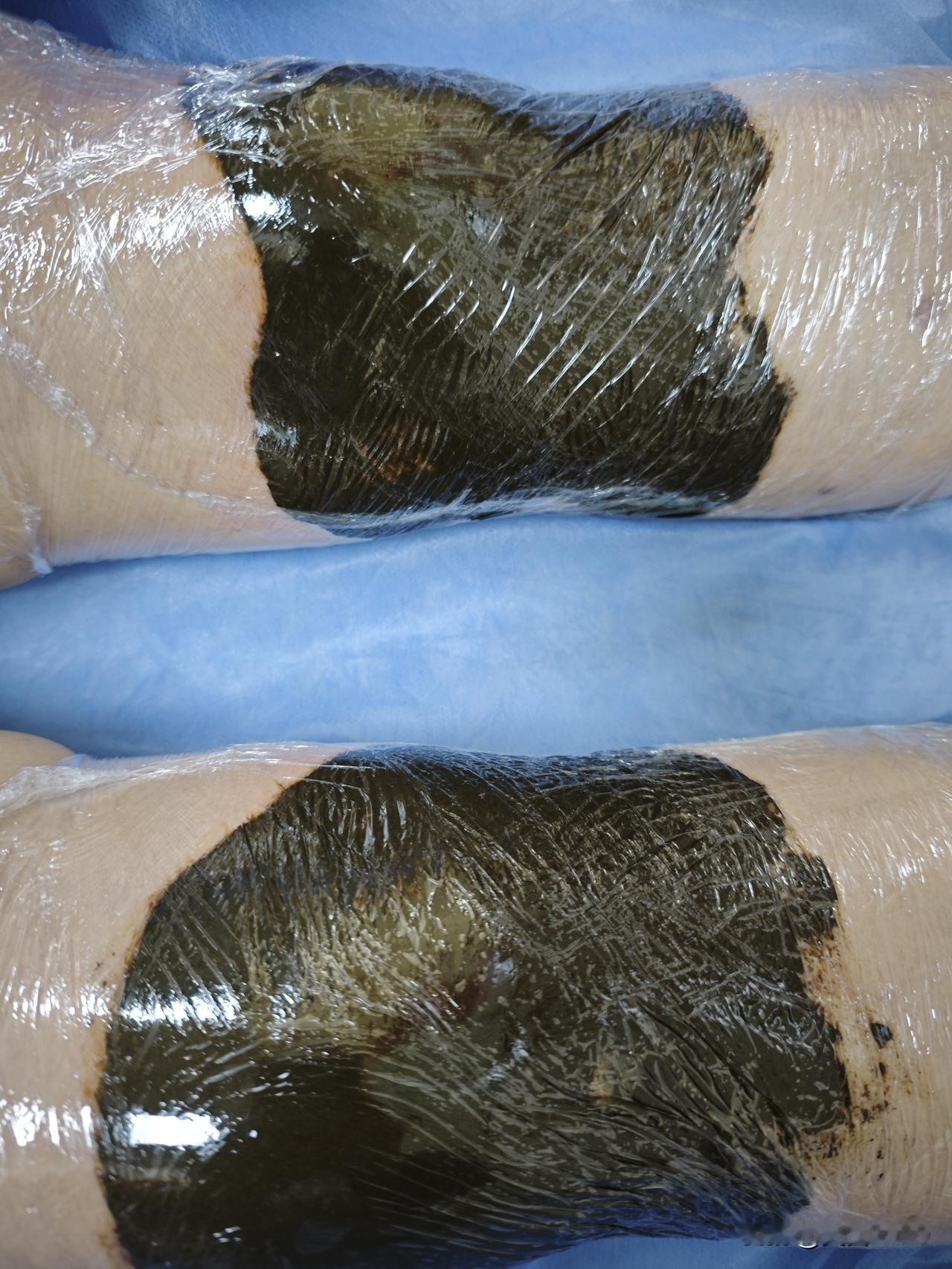 我今天又去找小周去了。我这个膝盖的问题还没解决，她说今天有时间，我就去找她给我敷