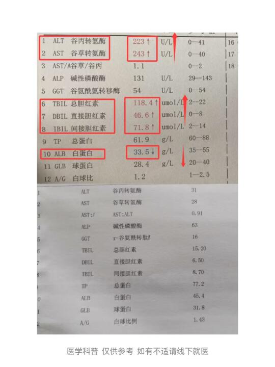 35岁年轻小伙10年乙肝的抗病毒治疗之路！