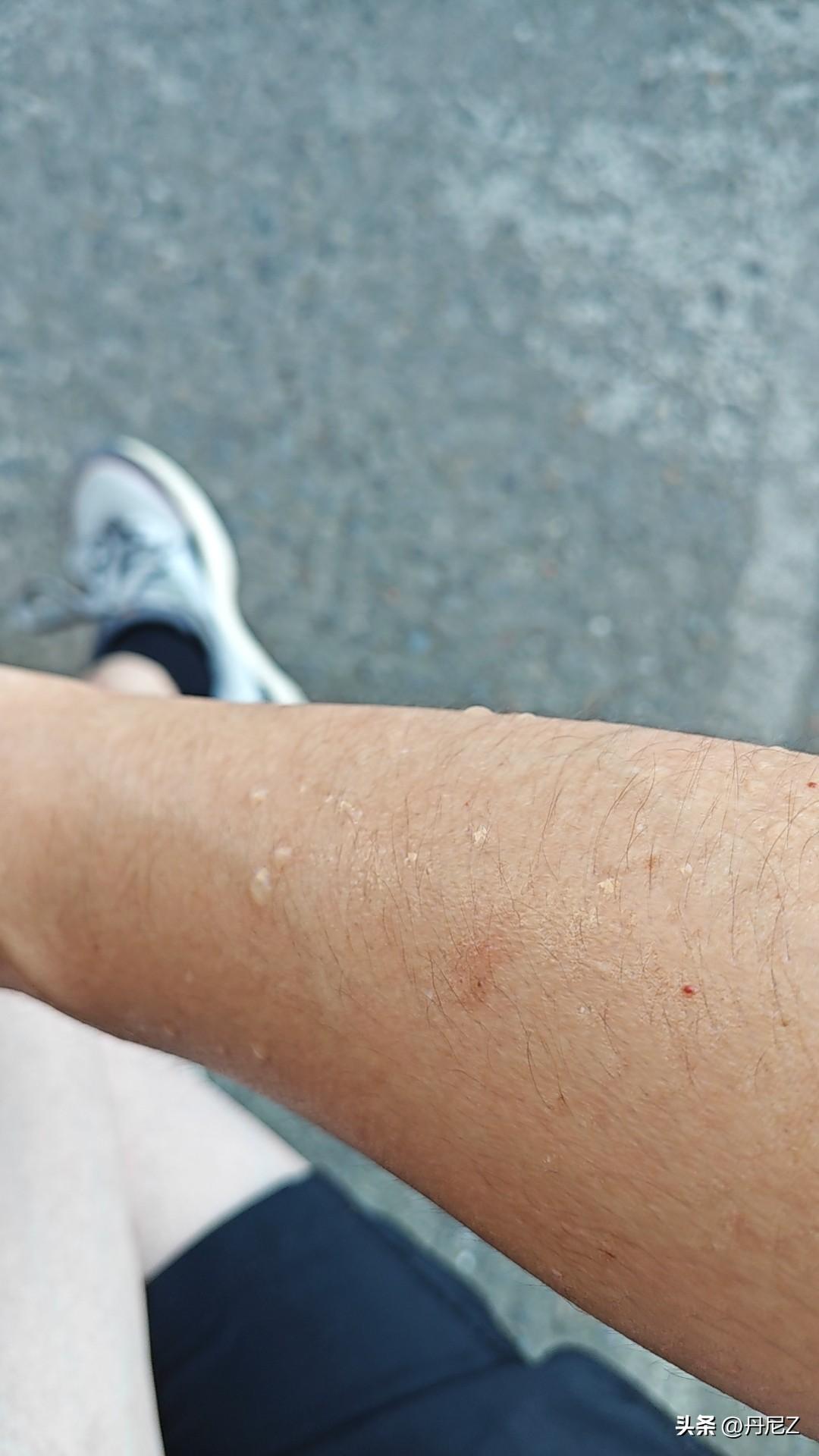 夏天蚊子为什么总是咬你? 🦟 蚊子为什么偏偏叮你，不叮旁边的人？

先给你吃颗