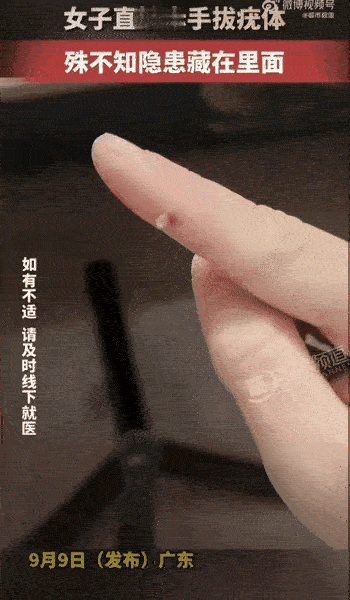 广东一名女生手上长出疣体，觉得只是小毛病，没放在心上。
她直接剪开皮肤小口，硬生