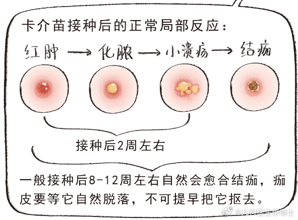 疫苗接种知识分享一则，卡介苗是用于预防儿童结核病的疫苗，接种卡介苗时，孩子们一般