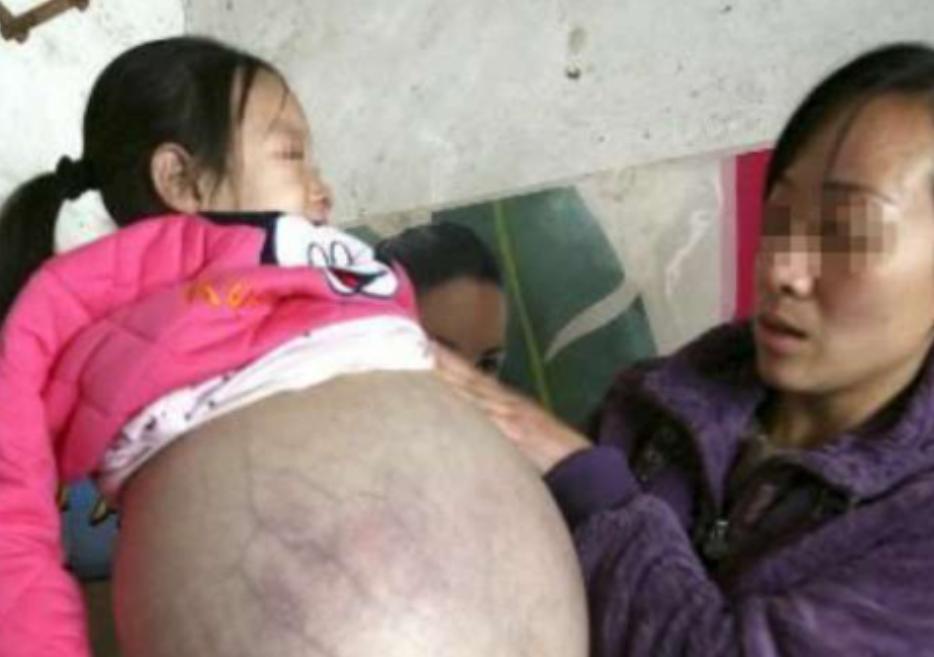 山西一4岁小女孩，肚子异常鼓胀，大得像足月孕妇。多家医生轮番诊断摇头说孩子活不过