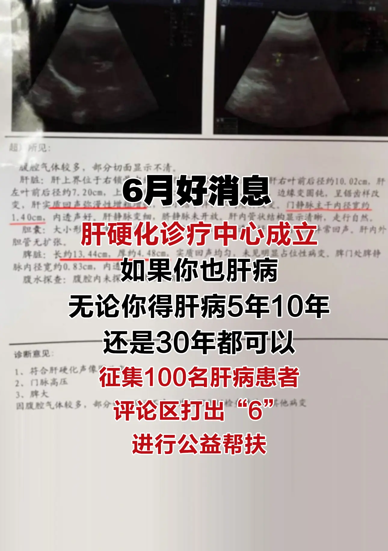 肝硬化 乙肝