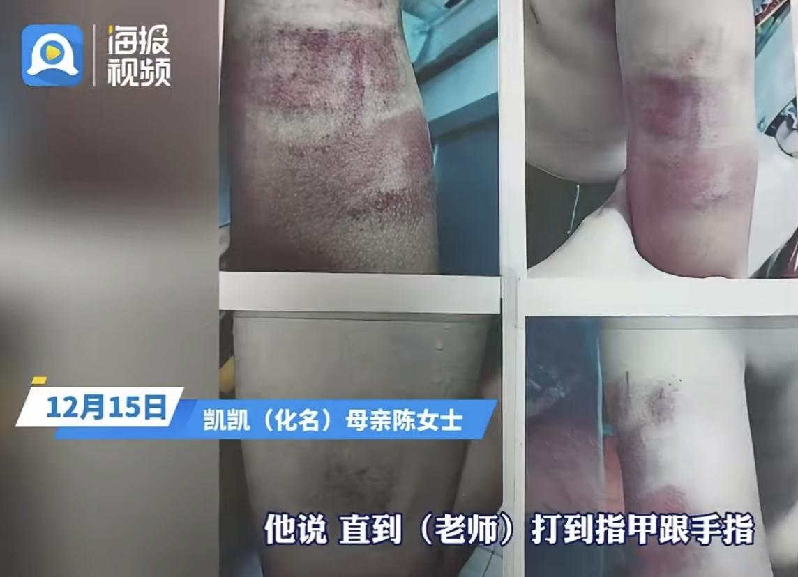 四年级学生凯凯弄丢了两张国庆作业卷，换来的不是老师的耐心询问，而是戒尺的抽打、拉