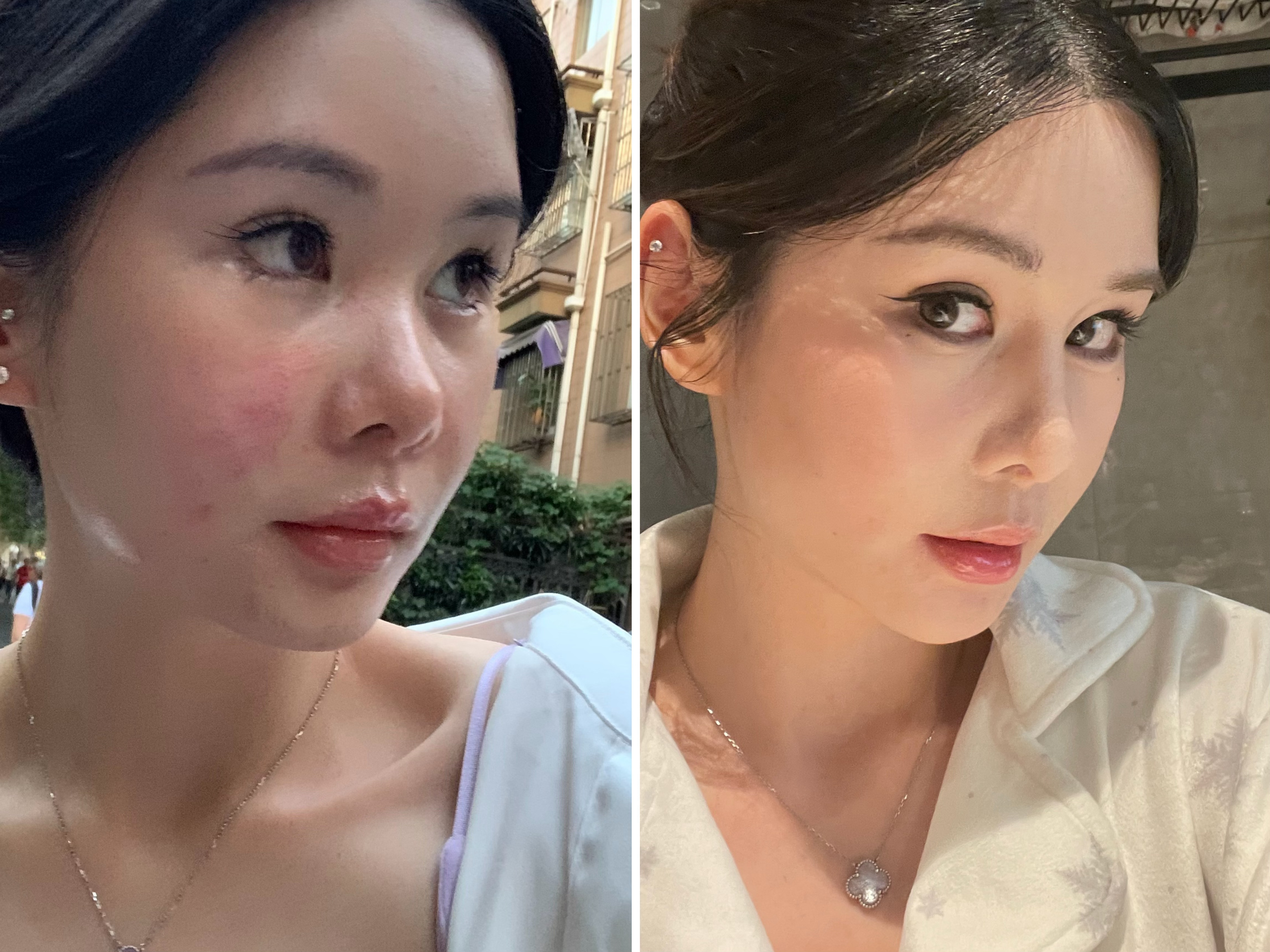 现在看之前刚打的鼻子的时候，注射真的是香啊！！ 