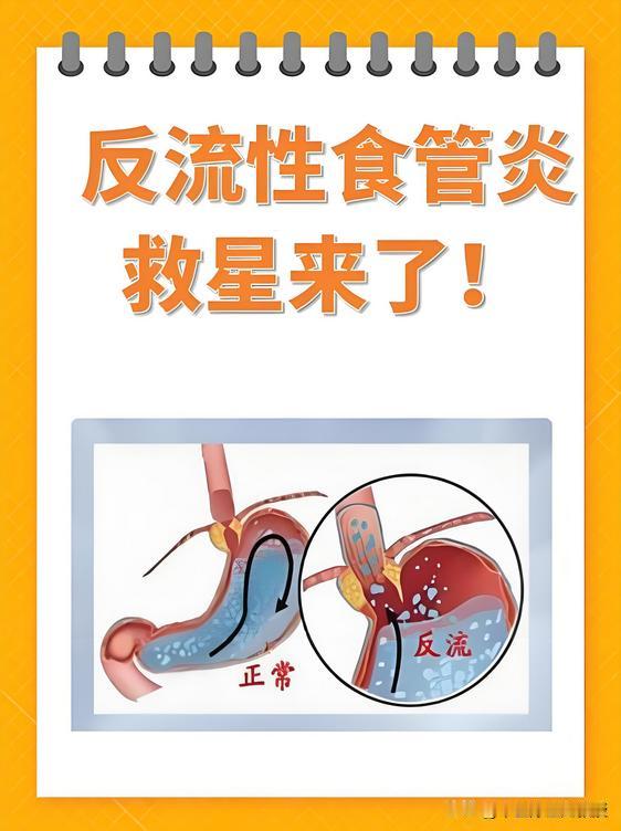 烧心胃痛难以忍受？分享一剂经典方，调畅气机、抑制胃酸，摆脱反流性食管炎的困扰！