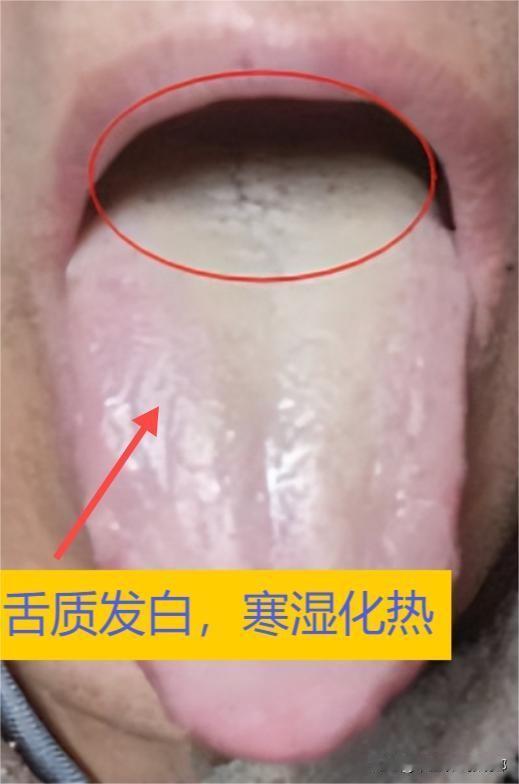 看见黄苔就清热，越清越严重，因为它就不是湿热，而是寒湿！

这位朋友的情况：大腿