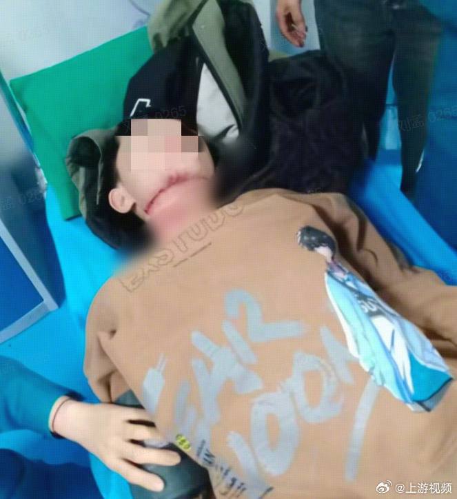 #13岁男孩骑车被绳索割喉最新进展#【家属讲述沁阳男孩骑车遭绳索割喉细节：仍有一