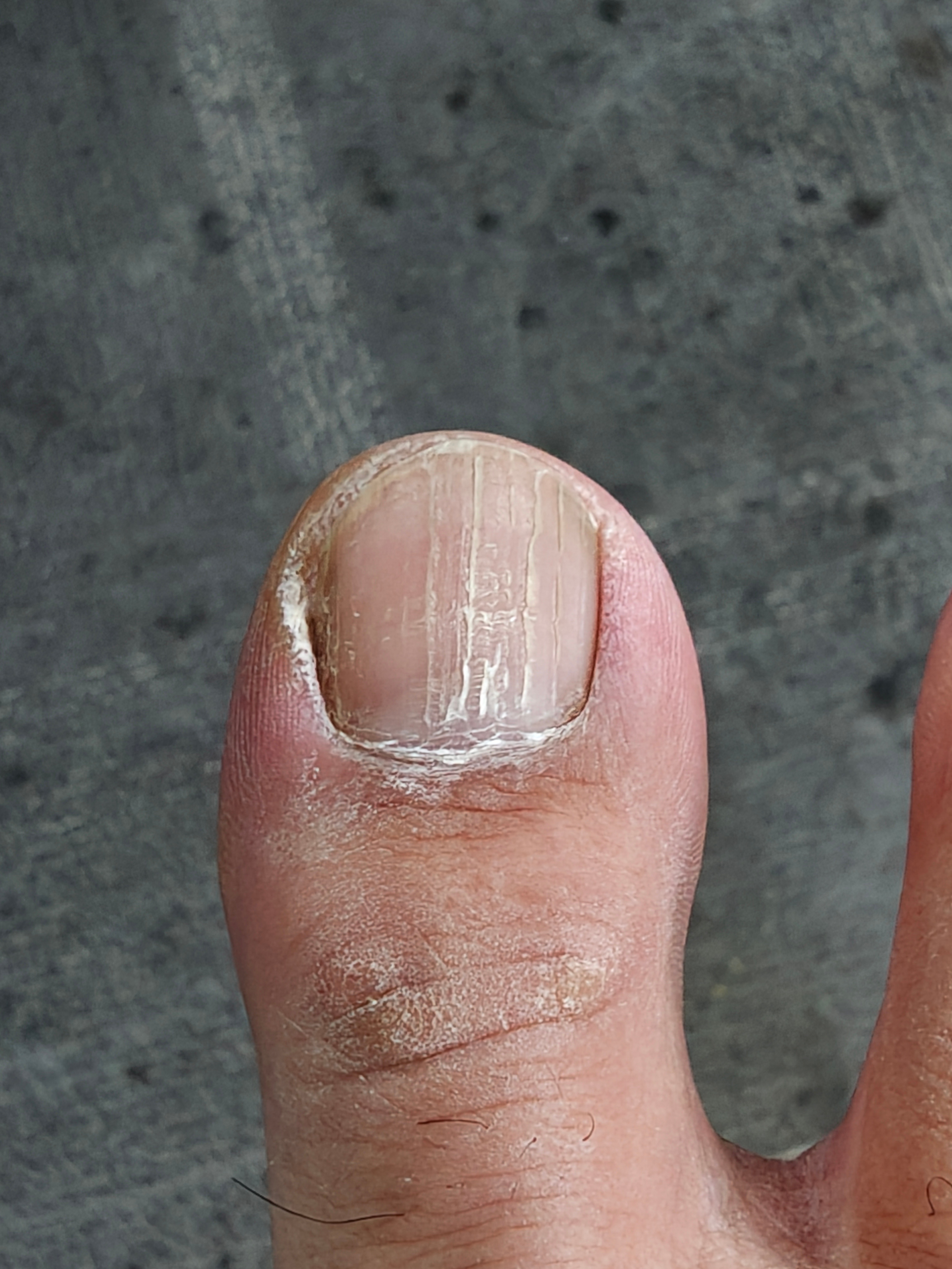 网上求医，我这个大脚趾出现竖纹，什么情况，用点啥药 ​​​