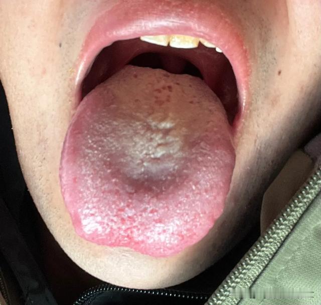 这个舌头，纯粹就是男科不行，自己补过头了[吐血][吐血][吐血]
说了别轻易进补