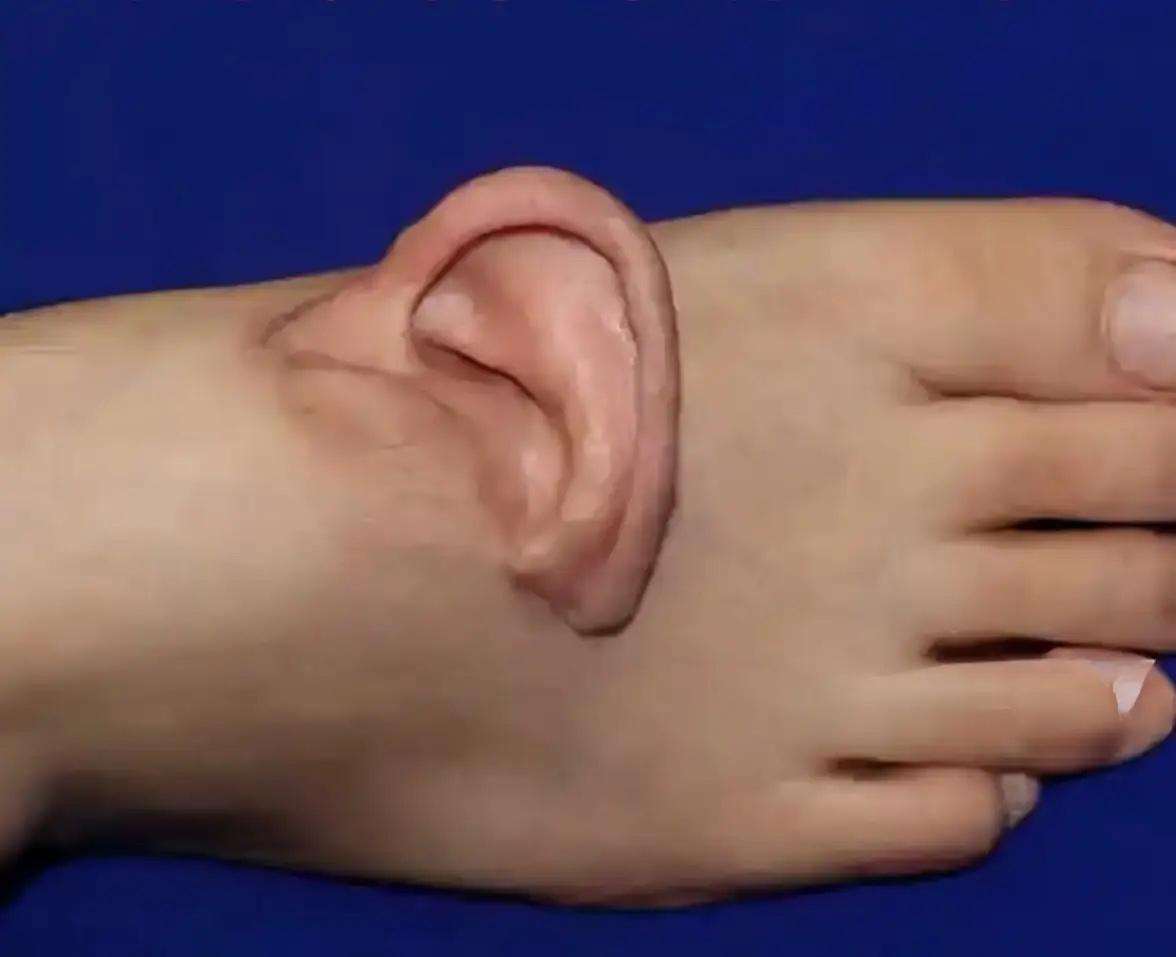 山东女子脚背上“长”耳朵？

这不是猎奇新闻，而是现代医学给生命的温柔托底！
