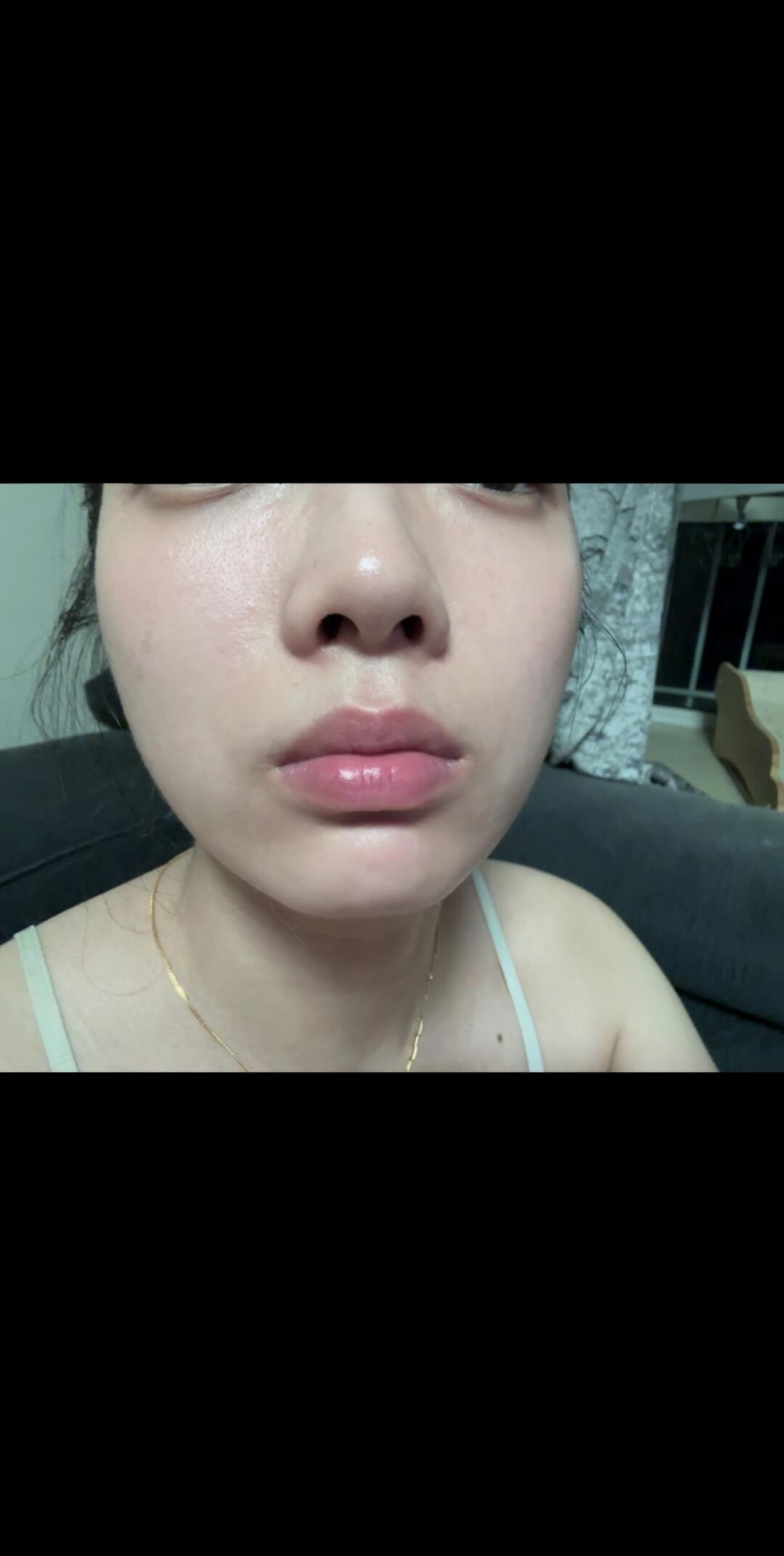 想玻尿酸丰唇有什么建议吗