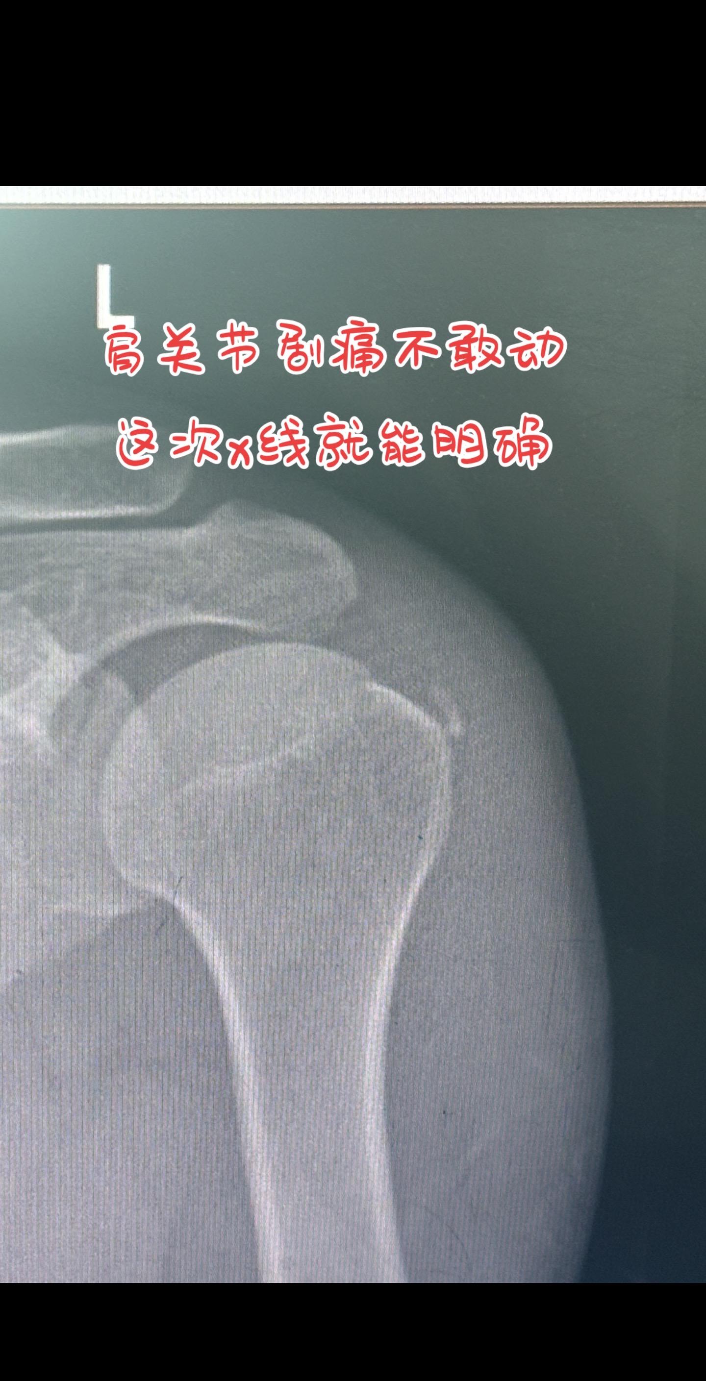 肩膀剧痛 这次x线就能诊断了。肩膀剧痛难忍 不敢活动怎么回事