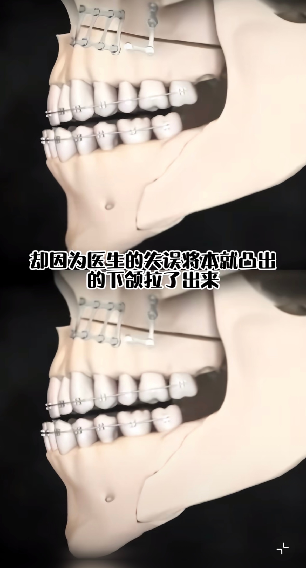 这本来就没必要正颌。before主要是缺面中，中上庭包不住下庭牙弓，同时缺颏形。