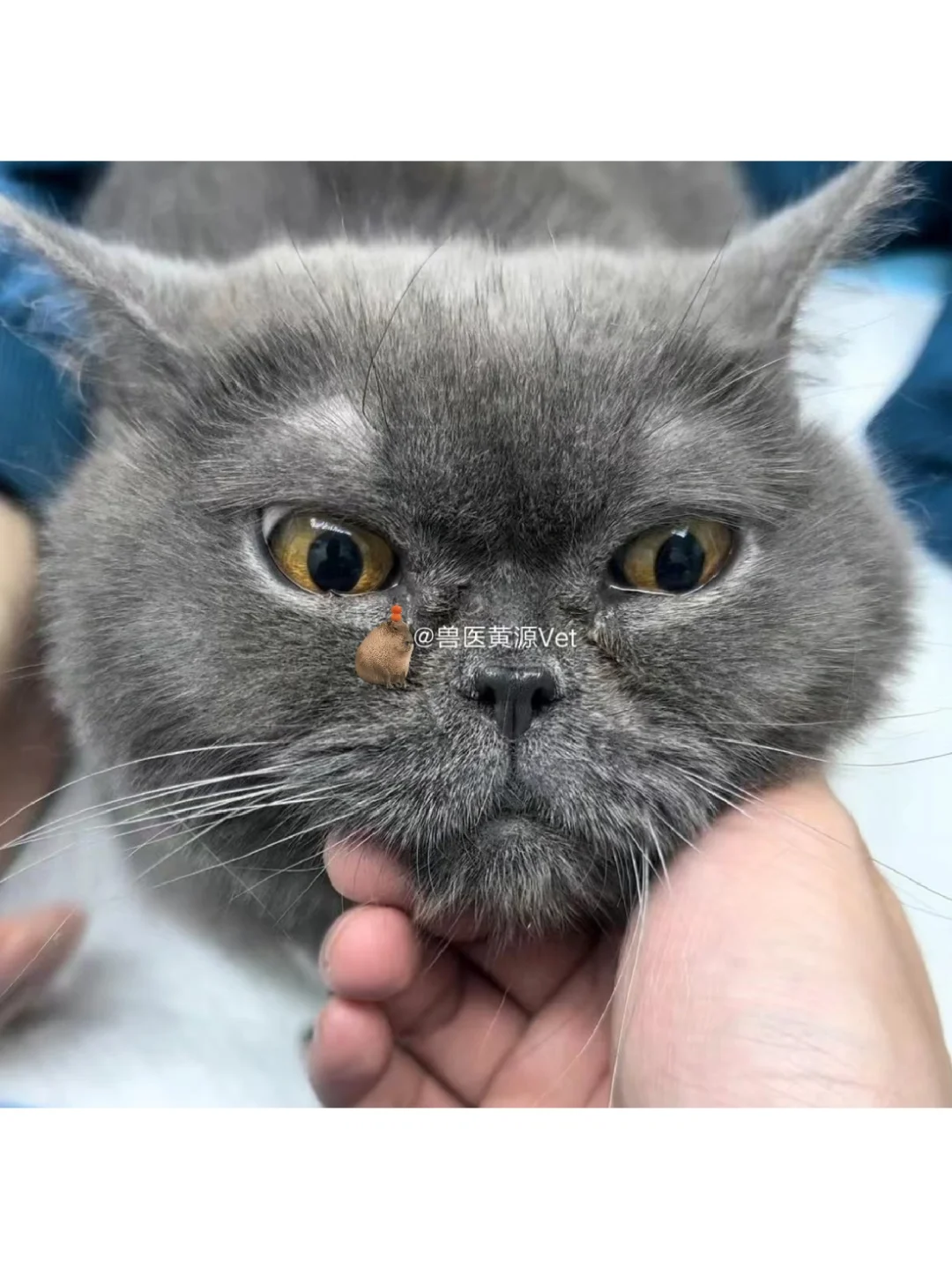 绝育后纱布被遗落在腹腔内整整六年