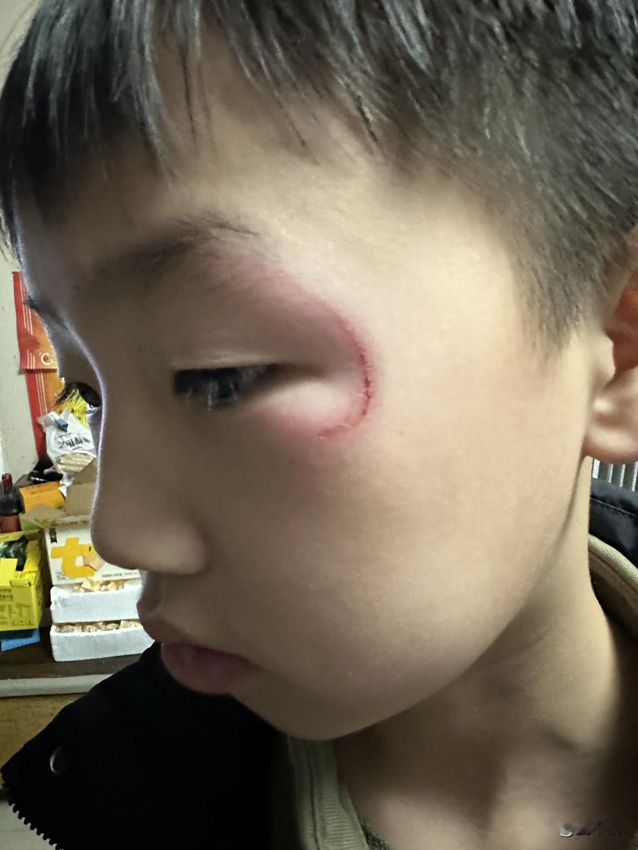 昨天下午5时许，突然接到老师的电话，说孩子在学校碰伤了眼睛，让我赶紧去接孩子看医