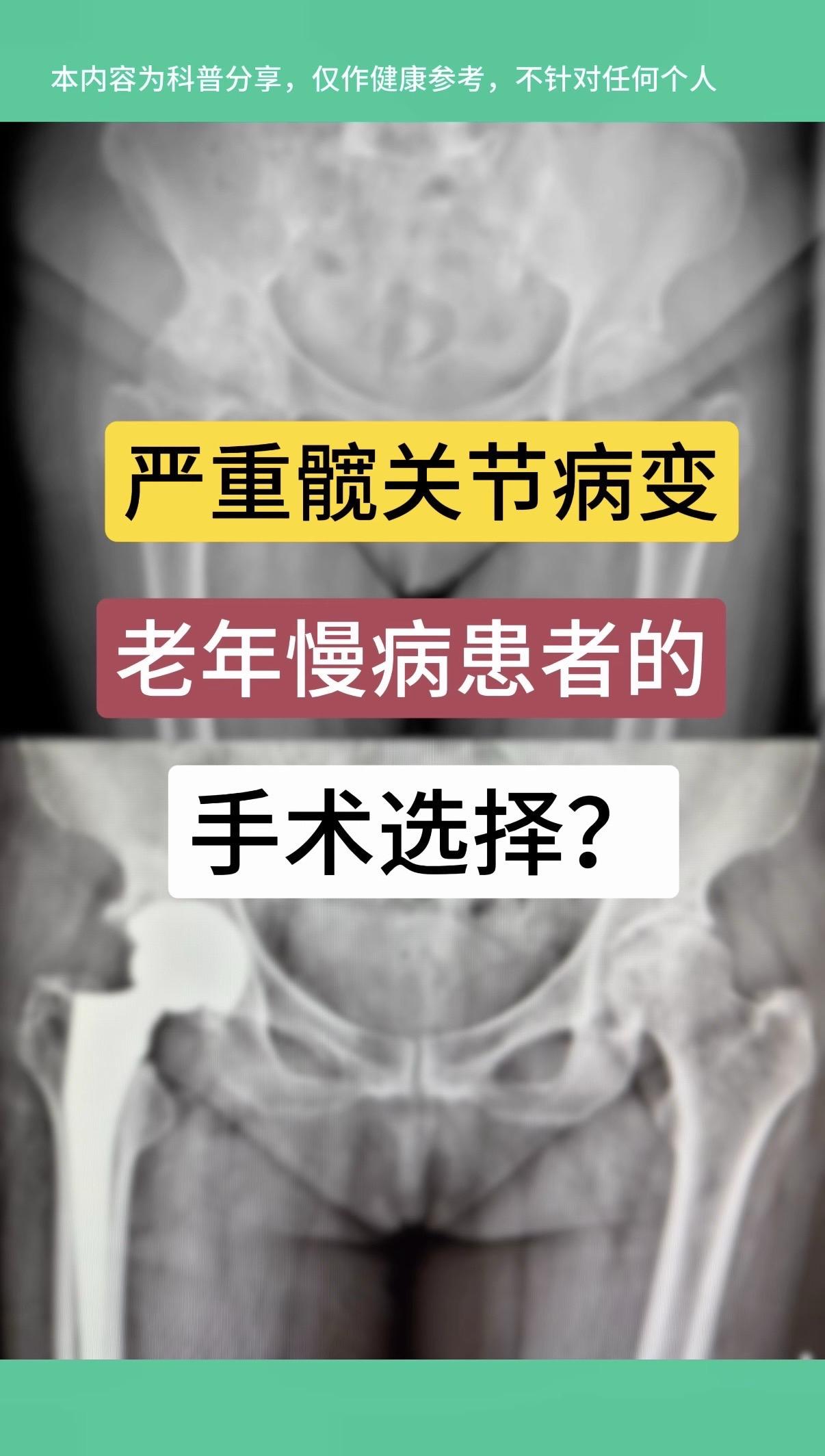 严重髋关节病变，老年慢病患者的手术选择？70岁女性，右髋骨性关节炎疼痛...