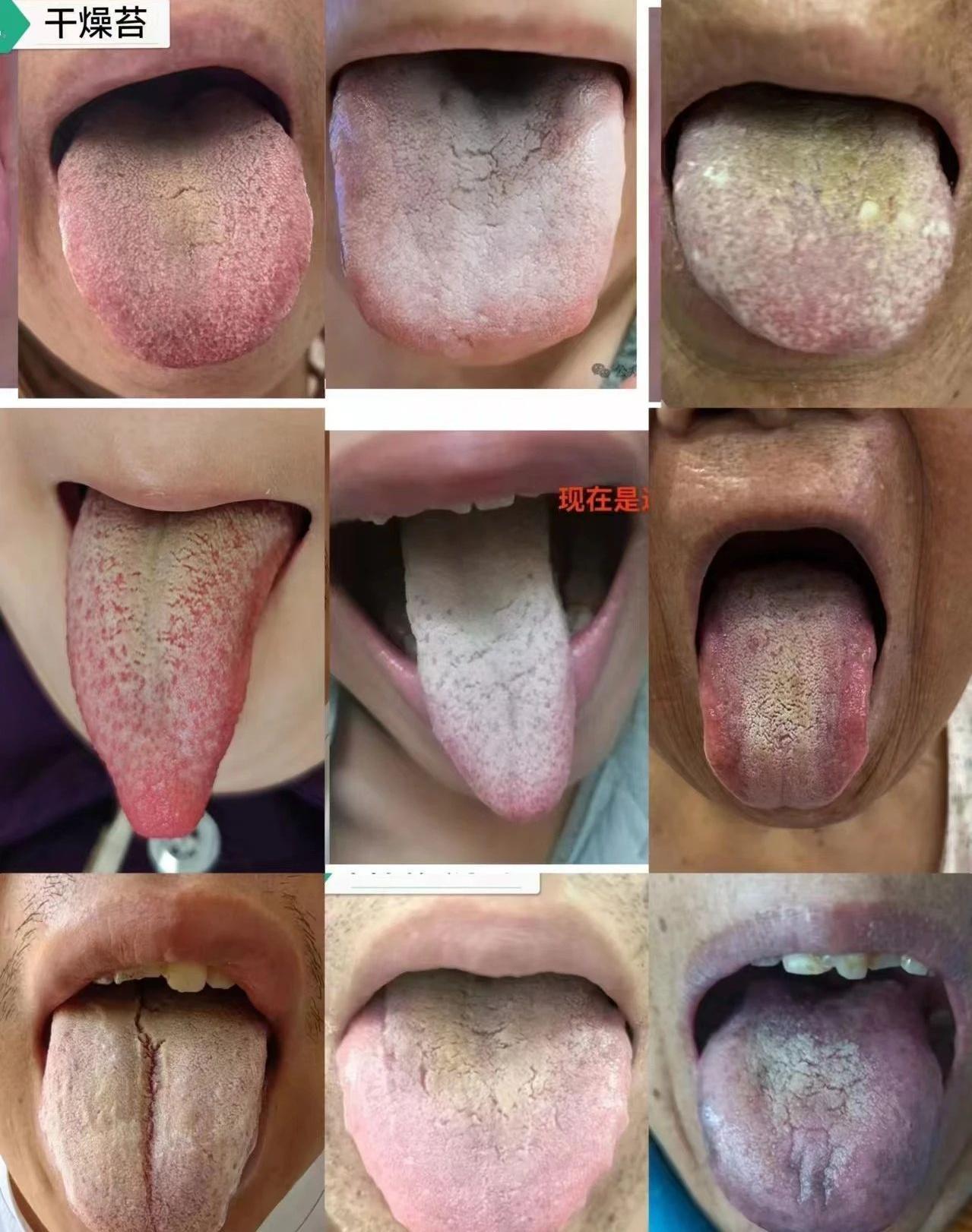 咳嗽的患者很多都是燥咳，大家通过这组照片，可以充分学习，燥舌的舌象特征。
1、看