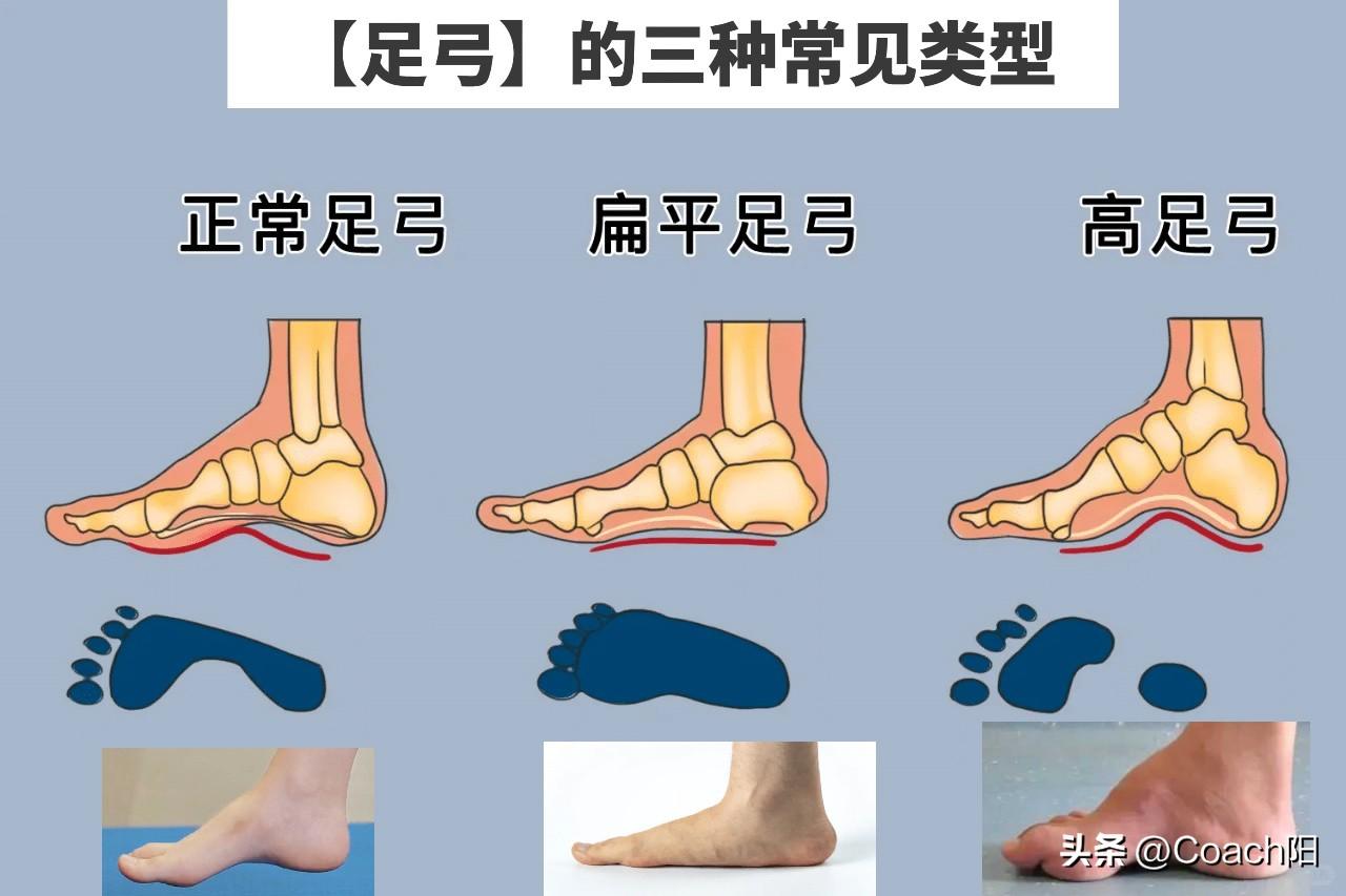 [灵光一闪]常见的3种【足弓】类型，你是哪一种？

俗话说：“千里之行、始于足下